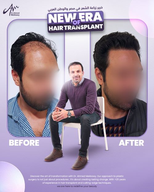  ما هي أفضل تقنيات زراعة الشعر في مصر ؟